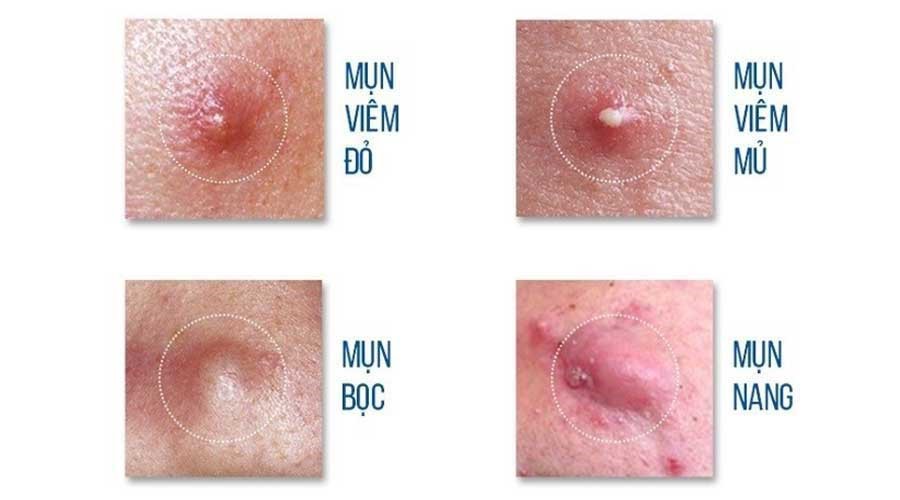 Mụn viêm bao gồm: viêm đỏ, viêm mủ, mụn bọc, mụn nang