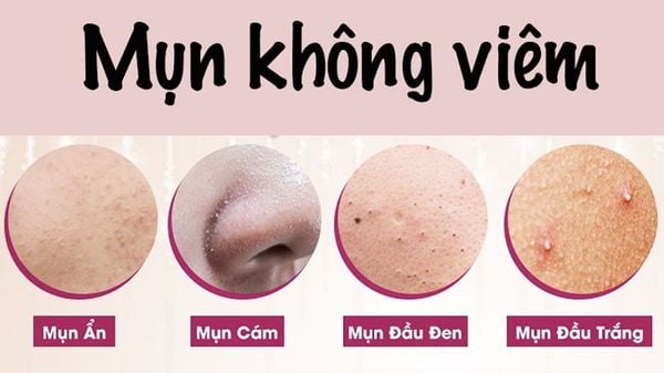 Mụn không viêm bao gồm: Mụn ẩn, mụn cám, mụn đầu đen, mụn đầu trắng