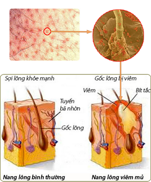 Không tẩy tế bào chết cũng là 1 phần gây nên mụn 